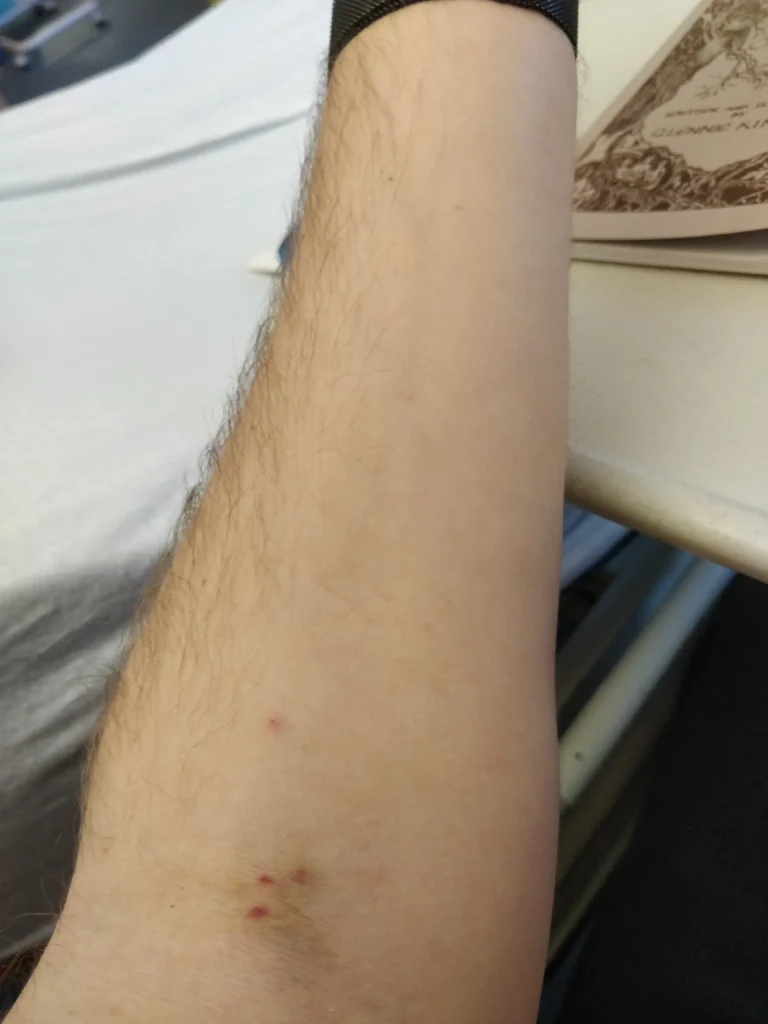 A photo of my arm with lots of bruising where canula's were placed